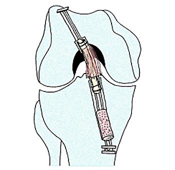 再建靱帯の両端は人工靱帯に連結し、上下端は金具で留める